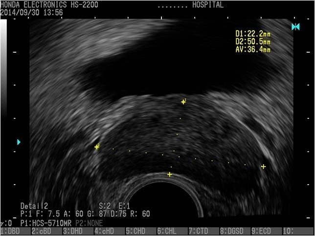 Bladder, prostate (transverse section)