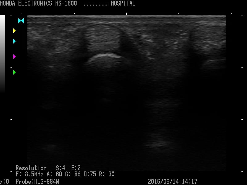 Tendon of middle finger (short axis)