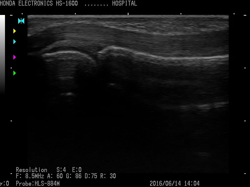 Tendon of middle finger (long axis)