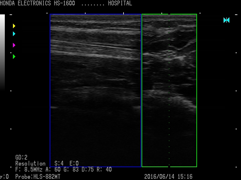 Median nerve