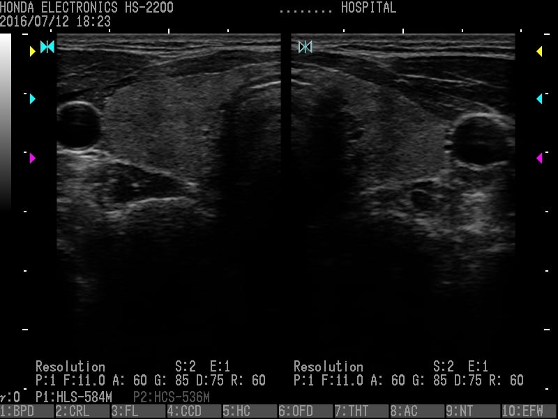 Thyroid gland