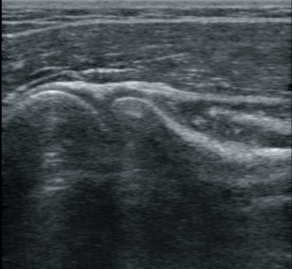 Phalanx tendon