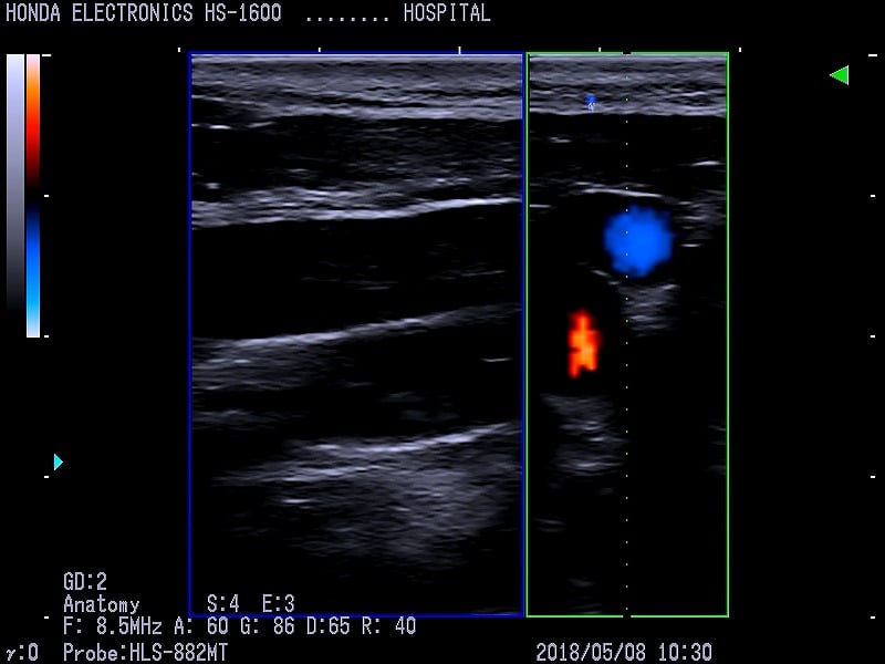 Carotid artery