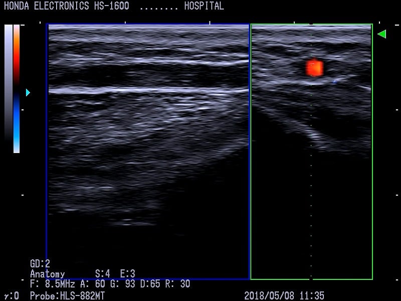 Radial artery